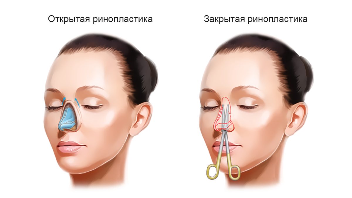 Types of access in rhinoplasty