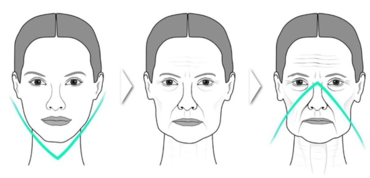 Перераспределение объема мягких тканей лица при старении - "треугольник молодости"
